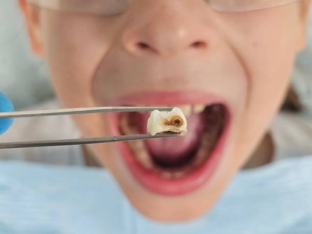 Best Emergency Dental Care for Broken or Chipped Teeth in Coeburn, VA